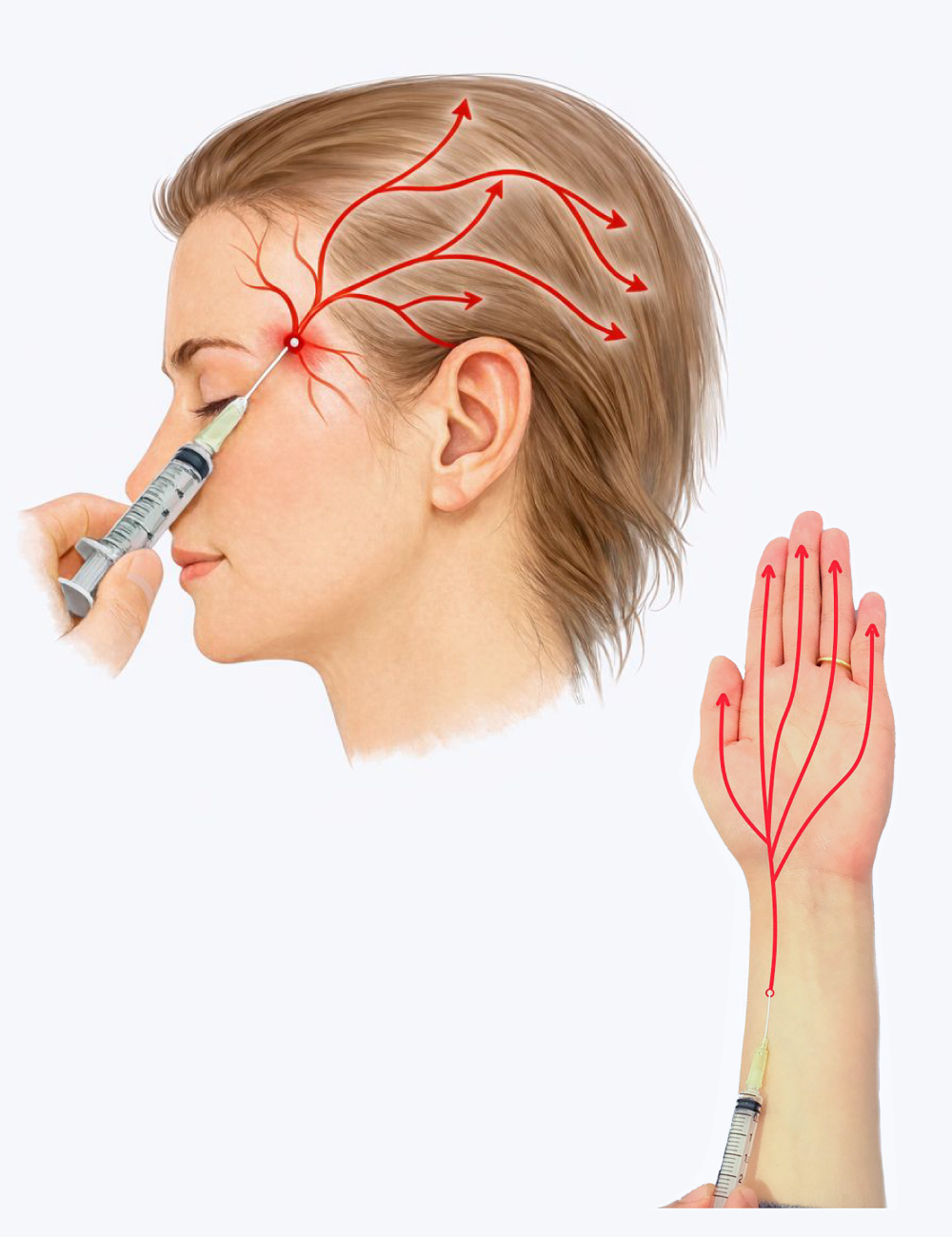 動注治療（動脈注射治療）イメージ