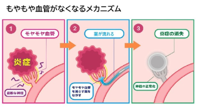 モヤモヤ血管がなくなるイメージ画像