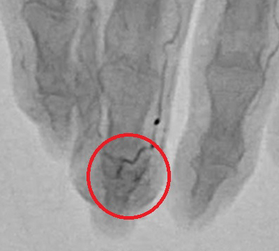 モヤモヤ血管画像